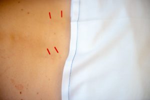 acupuncture needles