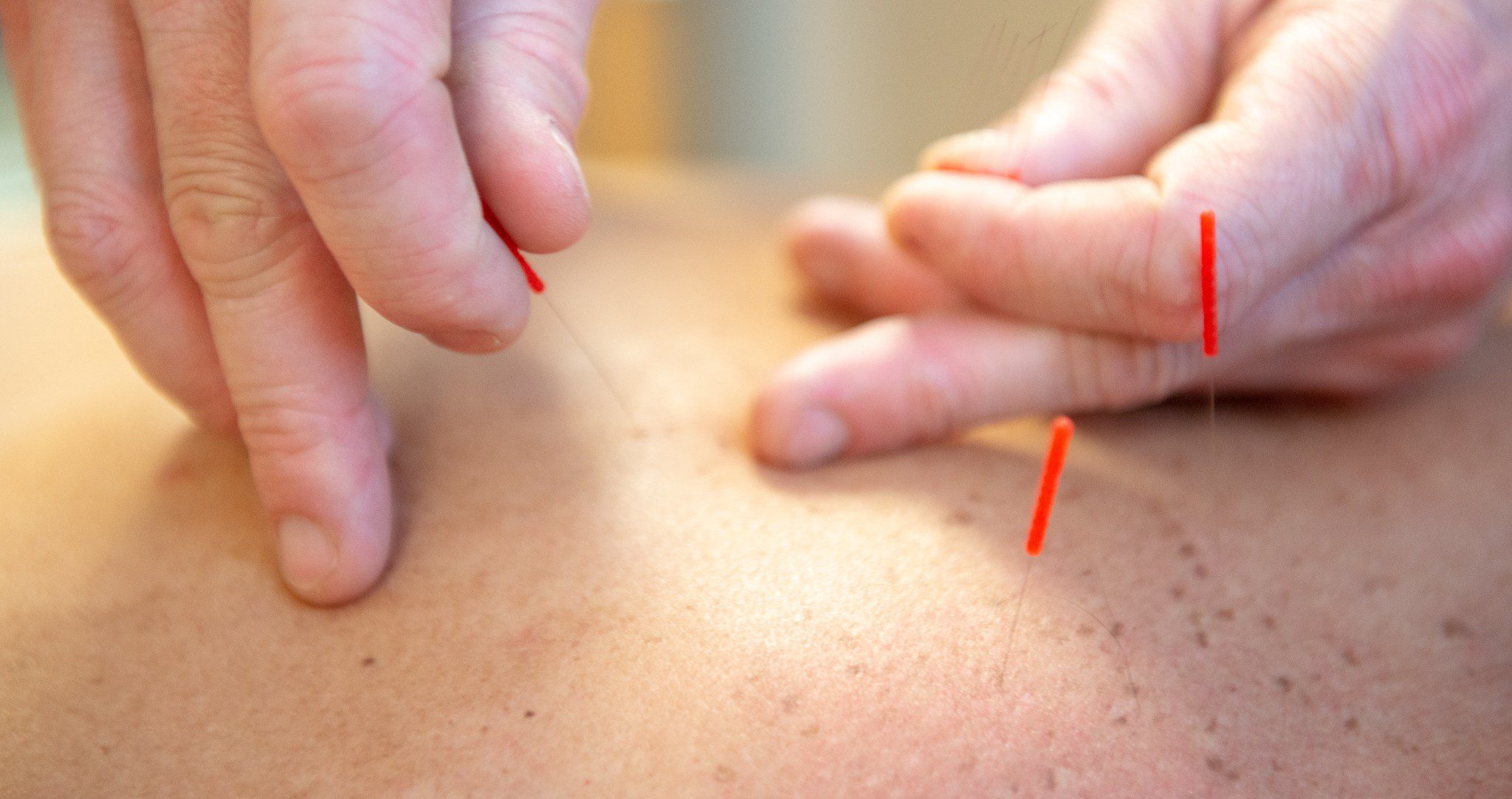 Dry needling