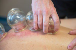 Fire cupping