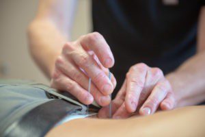 Placing acupuncture needles on patients lower back