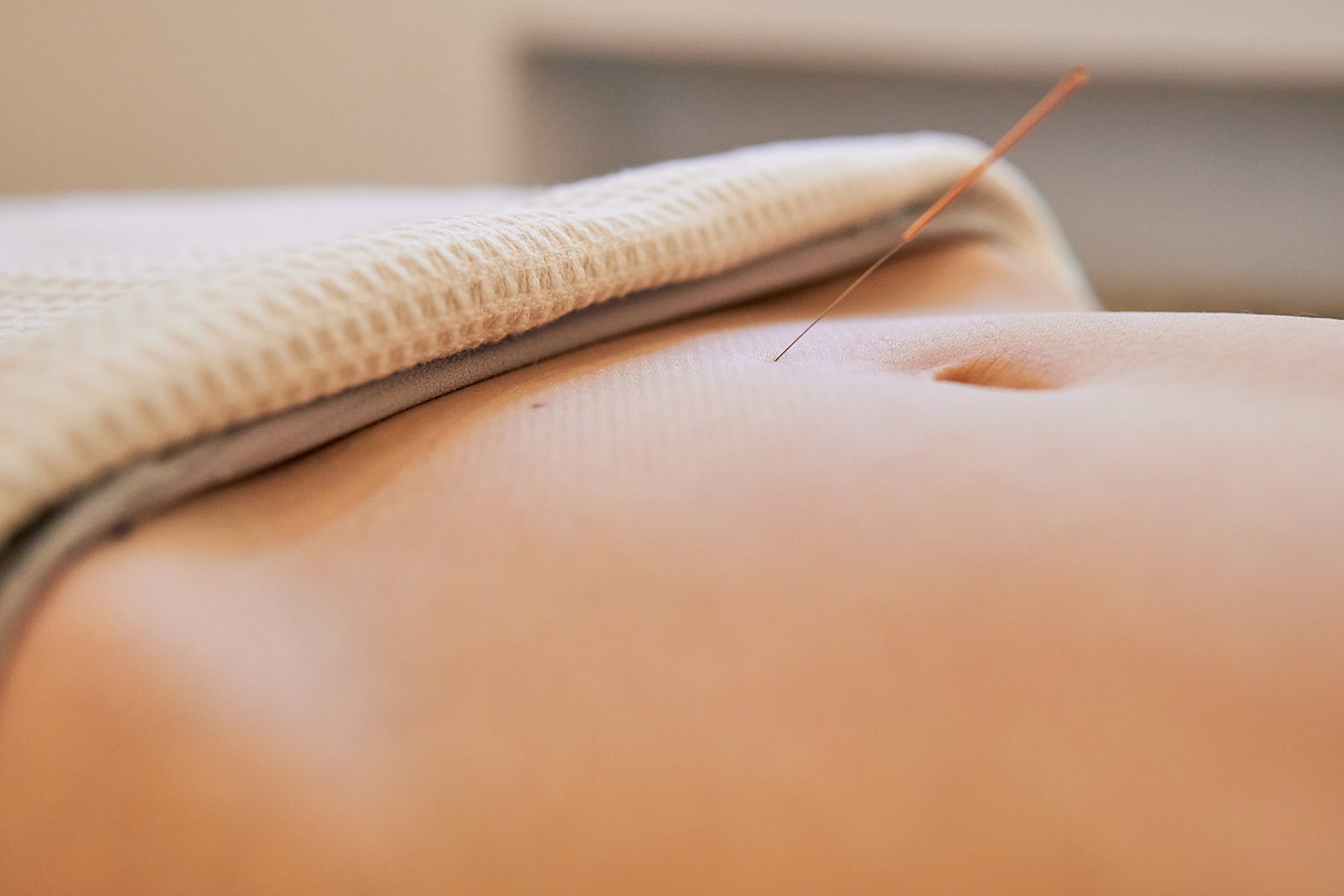 Acupuncture for Fertility: Supporting Reproductive Health Naturally
