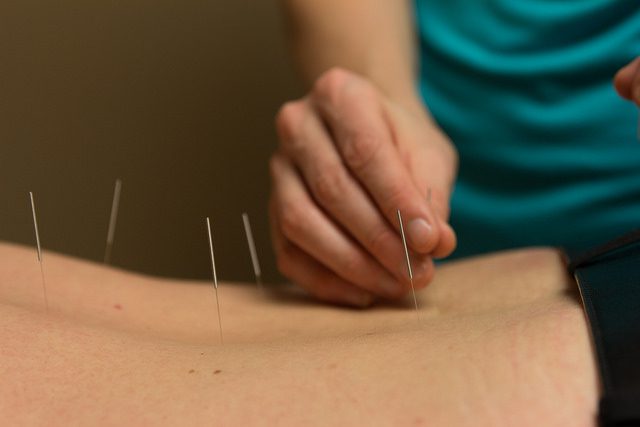 Benefits of Regular Acupuncture Treatments