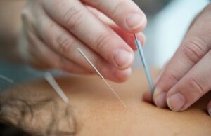 Acupuncturist placing needles into patient's back