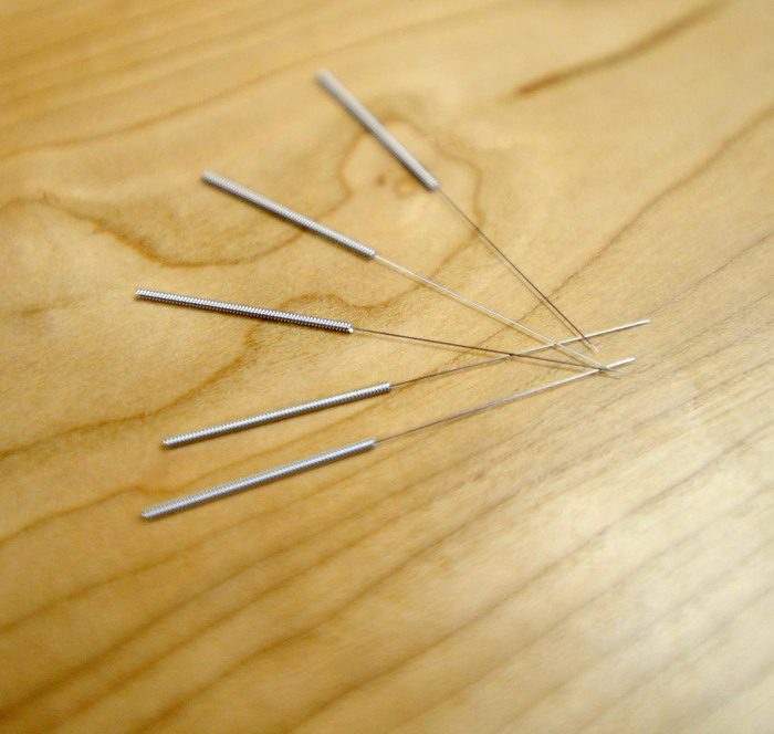 A History of Dry Needling
